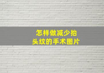 怎样做减少抬头纹的手术图片